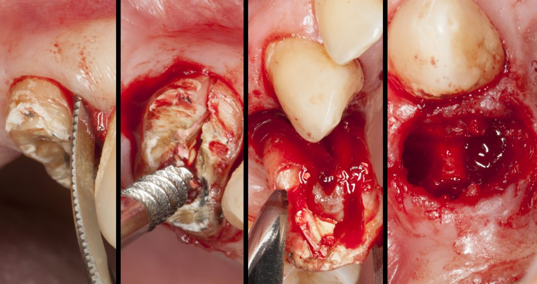 ¿Cómo prevenir la reabsorción ósea después de una extracción?