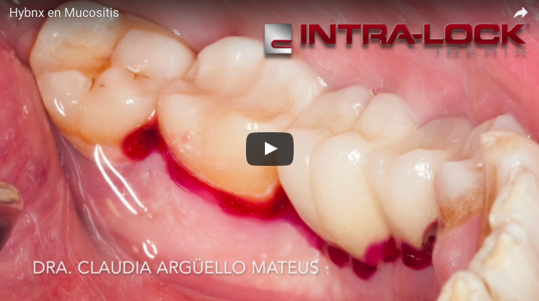 Tratamiento de mucositis con desconatimandor tisular HybenX