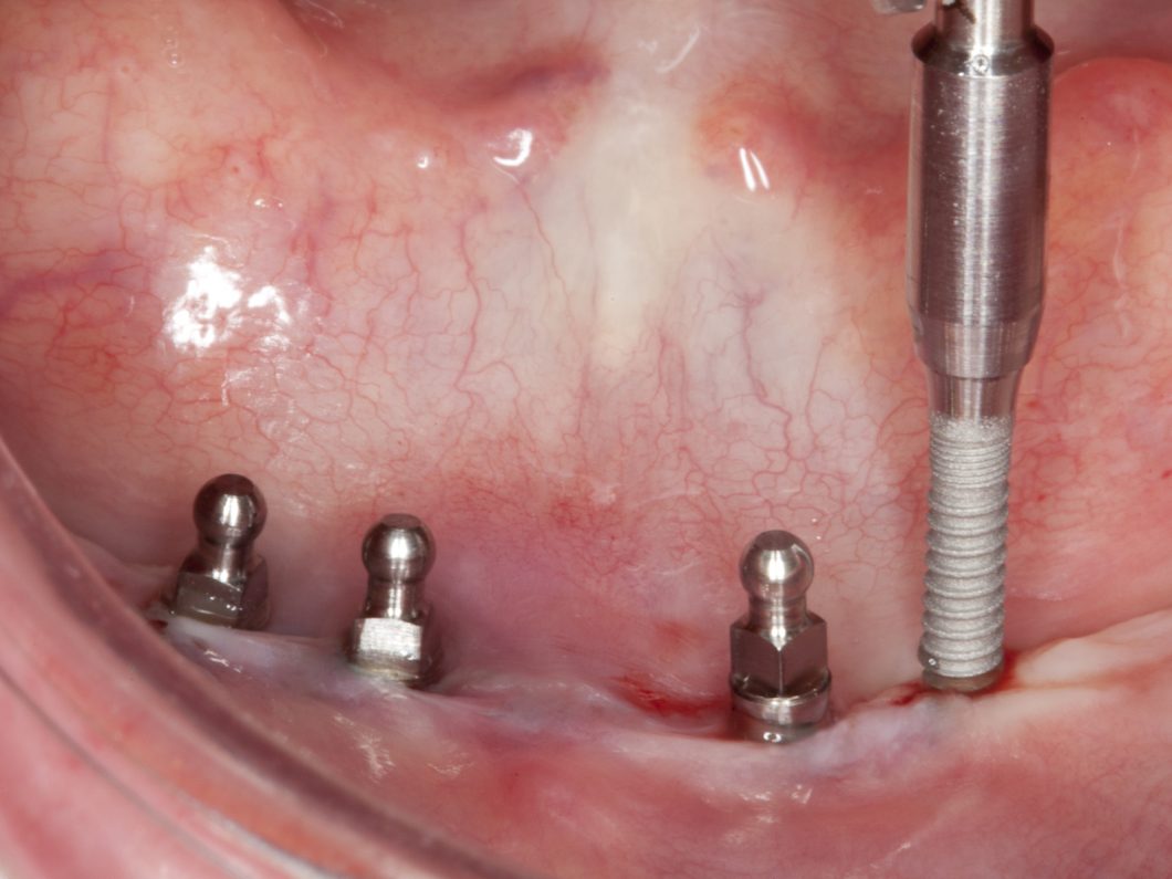 ¿Cuándo debemos utilizar los implantes de diámetro reducido?