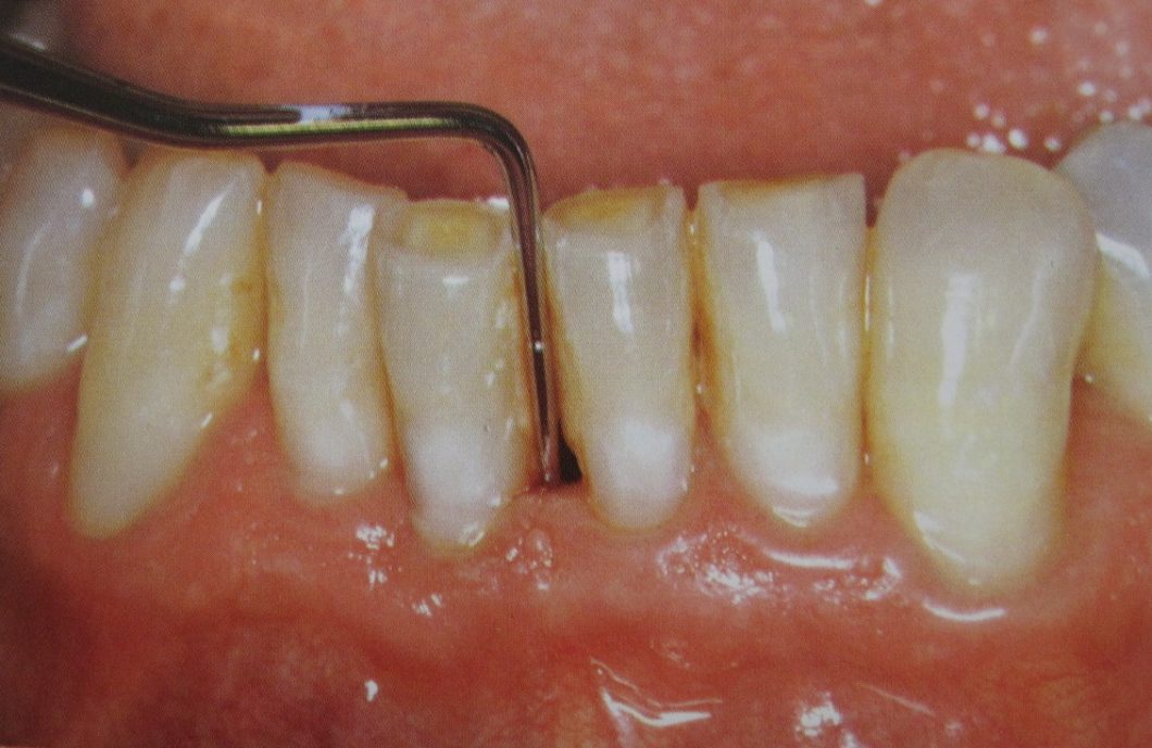Salud Periodontal y Periimplantaria