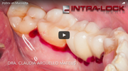 Tratamiento de mucositis con desconatimandor tisular HybenX