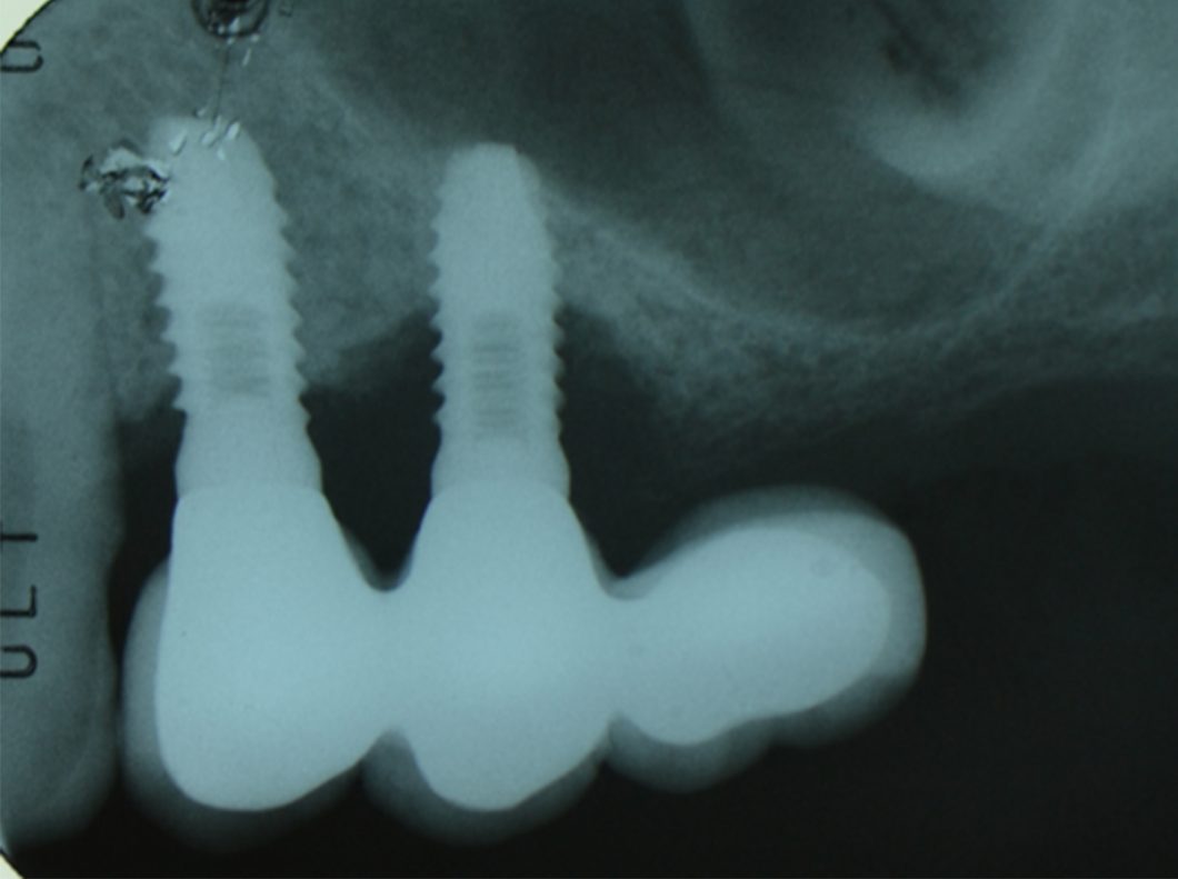 Prevención De Las Enfermedades Periimplantarias