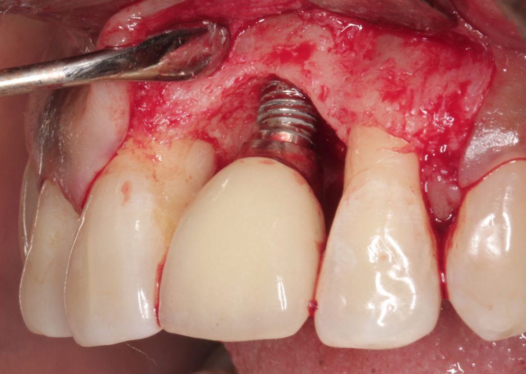 Terapia de Mantenimiento Periimplantario