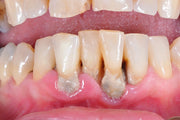 Asociación entre Enfermedad Periodontal y Enfermedades Sistémicas