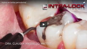 Hybnx en bolsa periodontal
